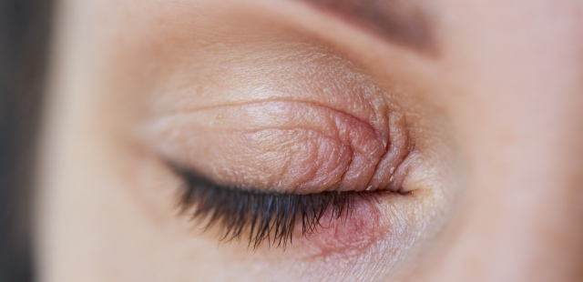 Pálpebras inflamadas? Tudo sobre a blefarite