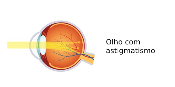 Representação do funcionamento de um olho com astigmatismo