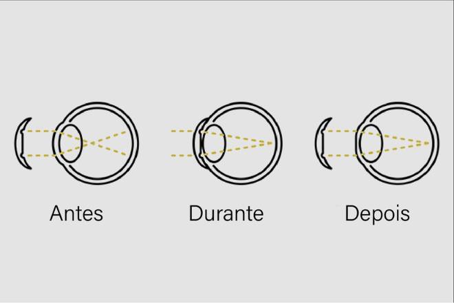 Explicação do funcionamento das lentes de contacto de ortoqueratologia