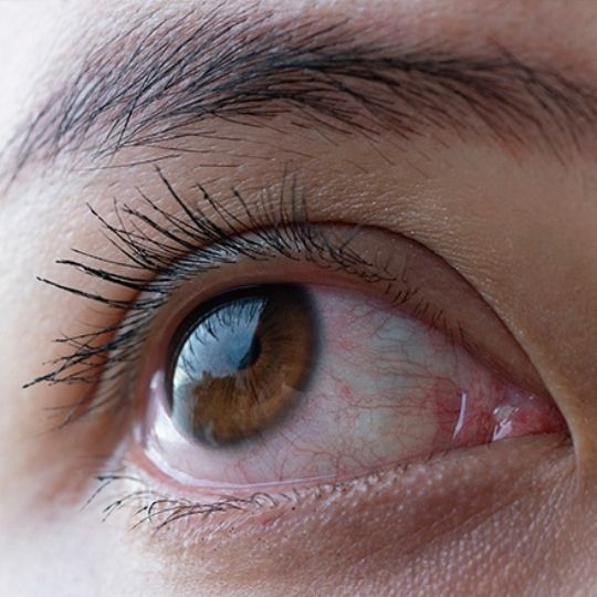 Primeiro plano de um olho com a tensão ocular alta