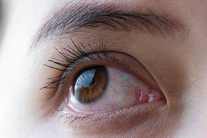 Primeiro plano de um olho com a tensão ocular alta